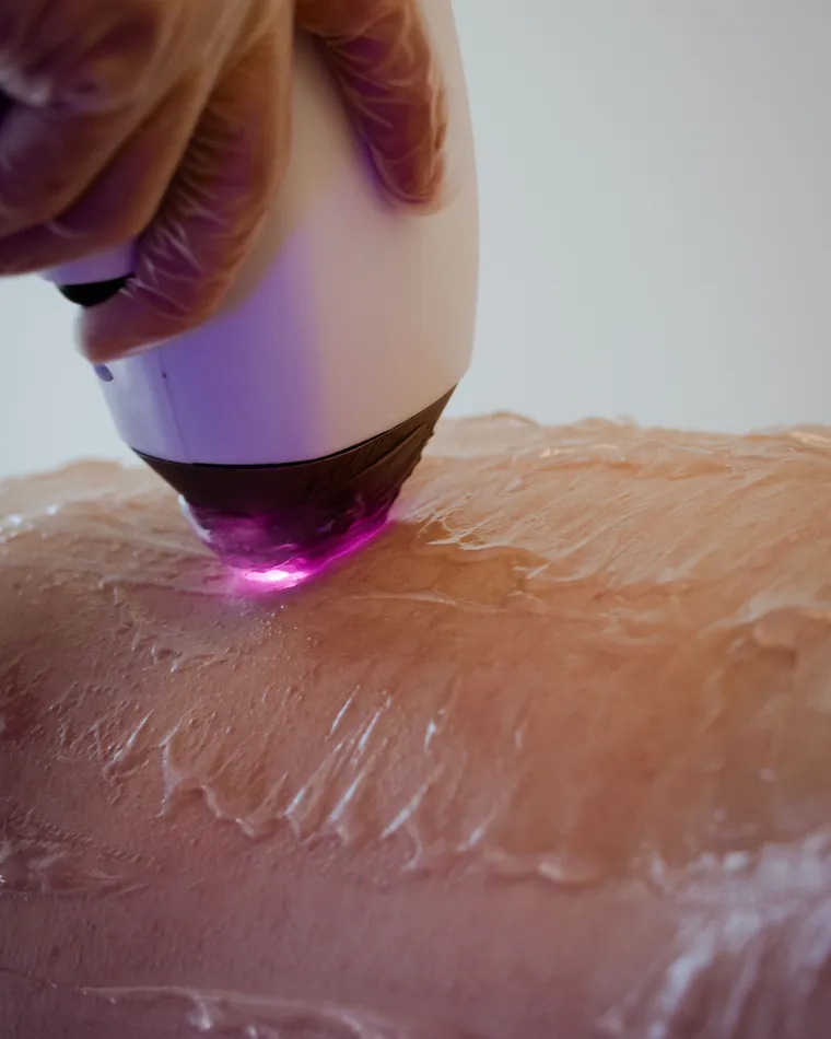 Ponteira de laser de diodo em contato com a pele preparada com gel